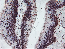 FMR1 / FMRP Antibody - IHC of paraffin-embedded Adenocarcinoma of Human colon tissue using anti-FMR1 mouse monoclonal antibody.
