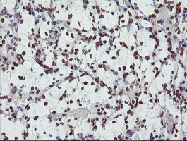 FMR1 / FMRP Antibody - IHC of paraffin-embedded Carcinoma of Human kidney tissue using anti-FMR1 mouse monoclonal antibody.