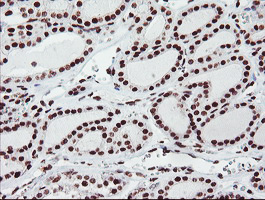 FMR1 / FMRP Antibody - IHC of paraffin-embedded Carcinoma of Human thyroid tissue using anti-FMR1 mouse monoclonal antibody.