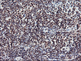 FMR1 / FMRP Antibody - IHC of paraffin-embedded Human lymphoma tissue using anti-FMR1 mouse monoclonal antibody.