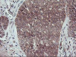 FMR1 / FMRP Antibody - IHC of paraffin-embedded Adenocarcinoma of Human ovary tissue using anti-FMR1 mouse monoclonal antibody.
