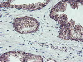 FMR1 / FMRP Antibody - IHC of paraffin-embedded Carcinoma of Human prostate tissue using anti-FMR1 mouse monoclonal antibody.