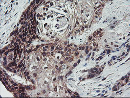 FMR1 / FMRP Antibody - IHC of paraffin-embedded Carcinoma of Human bladder tissue using anti-FMR1 mouse monoclonal antibody.
