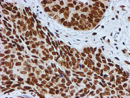 FMR1 / FMRP Antibody - IHC of paraffin-embedded Carcinoma of Human lung tissue using anti-FMR1 mouse monoclonal antibody.