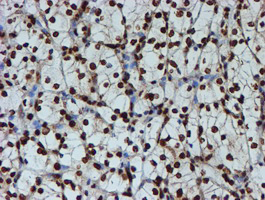 FMR1 / FMRP Antibody - IHC of paraffin-embedded Carcinoma of Human kidney tissue using anti-FMR1 mouse monoclonal antibody.
