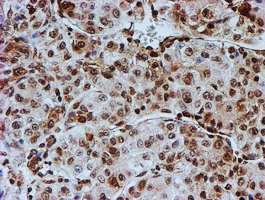FMR1 / FMRP Antibody - IHC of paraffin-embedded Carcinoma of Human liver tissue using anti-FMR1 mouse monoclonal antibody.
