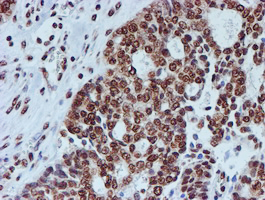 FMR1 / FMRP Antibody - IHC of paraffin-embedded Adenocarcinoma of Human ovary tissue using anti-FMR1 mouse monoclonal antibody.
