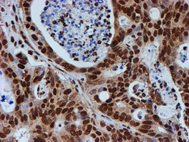 FMR1 / FMRP Antibody - IHC of paraffin-embedded Carcinoma of Human pancreas tissue using anti-FMR1 mouse monoclonal antibody.