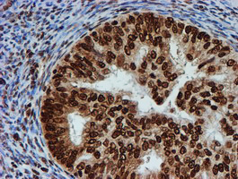 FMR1 / FMRP Antibody - IHC of paraffin-embedded Adenocarcinoma of Human endometrium tissue using anti-FMR1 mouse monoclonal antibody.