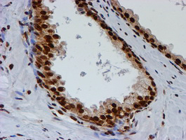 FMR1 / FMRP Antibody - IHC of paraffin-embedded Carcinoma of Human prostate tissue using anti-FMR1 mouse monoclonal antibody.