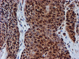 FMR1 / FMRP Antibody - IHC of paraffin-embedded Carcinoma of Human bladder tissue using anti-FMR1 mouse monoclonal antibody.