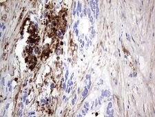 FN1 / Fibronectin Antibody - IHC of paraffin-embedded Adenocarcinoma of Human colon tissue using anti-FN1 mouse monoclonal antibody. (Heat-induced epitope retrieval by 1 mM EDTA in 10mM Tris, pH8.5, 120°C for 3min).