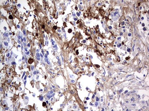 FN1 / Fibronectin Antibody - IHC of paraffin-embedded Adenocarcinoma of Human ovary tissue using anti-FN1 mouse monoclonal antibody. (Heat-induced epitope retrieval by 1 mM EDTA in 10mM Tris, pH8.5, 120°C for 3min).