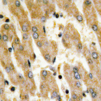 FN1 / Fibronectin Antibody - Immunohistochemical analysis of Fibronectin staining in human liver cancer formalin fixed paraffin embedded tissue section. The section was pre-treated using heat mediated antigen retrieval with sodium citrate buffer (pH 6.0). The section was then incubated with the antibody at room temperature and detected using an HRP conjugated compact polymer system. DAB was used as the chromogen. The section was then counterstained with hematoxylin and mounted with DPX.