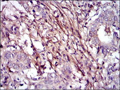 FN1 / Fibronectin Antibody - Immunohistochemistry-Paraffin: Fibronectin Antibody (2F4) - Immunohistochemical analysis of paraffin-embedded stomach cancer tissues using Fibronectin mouse mAb with DAB staining.