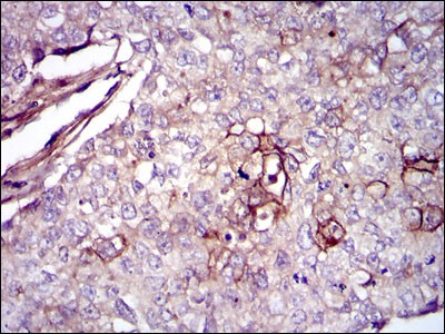 FN1 / Fibronectin Antibody - Immunohistochemistry-Paraffin: Fibronectin Antibody (2F4) - Immunohistochemical analysis of paraffin-embedded lung cancer tissues using Fibronectin mouse mAb with DAB staining.