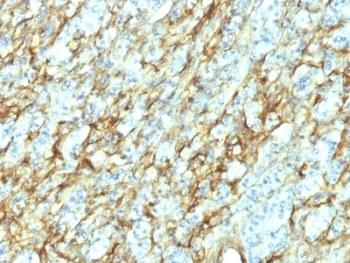 FN1 / Fibronectin Antibody - Formalin-fixed, paraffin-embedded human renal cell carcinoma stained with Fibronectin antibody (568).  This image was taken for the unmodified form of this product. Other forms have not been tested.