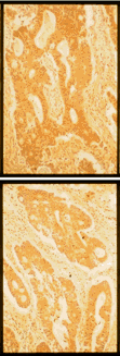 FN1 / Fibronectin Antibody - Staining of fibronectin (FN) in human well-differentiated colon cancer tissue (bottom) and moderatelydifferentiated colon cancer