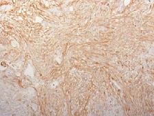 FN1 / Fibronectin Antibody - IHC testing of FFPE pancreatic adenocarcinoma and Fibronectin antibody (clone HFN7.1) This image was taken for the unmodified form of this product. Other forms have not been tested.