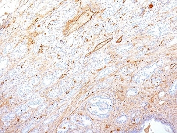 FN1 / Fibronectin Antibody - Formalin-fixed, paraffin-embedded human pancreatic adenocarcinoma stained with Fibronectin antibody (SPM246).  This image was taken for the unmodified form of this product. Other forms have not been tested.