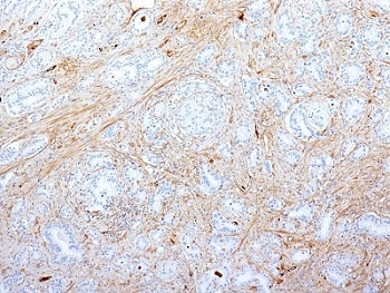 FN1 / Fibronectin Antibody - Formalin-fixed, paraffin-embedded human pancreatic adenocarcinoma stained with Fibronectin antibody (SPM539).  This image was taken for the unmodified form of this product. Other forms have not been tested.