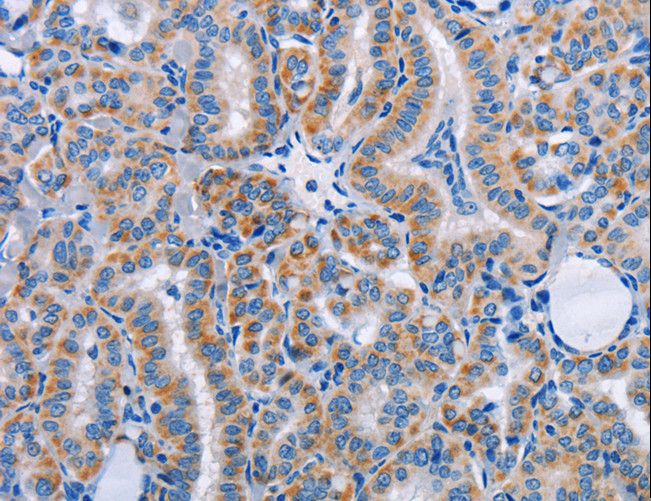 FN1 / Fibronectin Antibody - Immunohistochemistry of paraffin-embedded Human thyroid cancer using FN1 Polyclonal Antibody at dilution of 1:50.