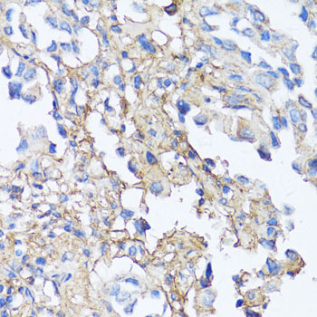 FN1 / Fibronectin Antibody - Immunohistochemistry of paraffin-embedded human lung cancer using FN1 antibody at dilution of 1:150 (40x lens).