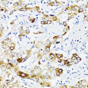 FN1 / Fibronectin Antibody - Immunohistochemistry of paraffin-embedded human liver cancer using FN1 antibody at dilution of 1:100 (40x lens).