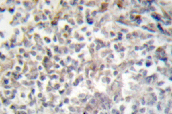 FN1 / Fibronectin Antibody - IHC of Fibronectin 1 (F2372) pAb in paraffin-embedded human lung carcinoma tissue.