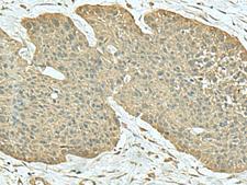 FN3KL / FN3KRP Antibody - Immunohistochemistry of paraffin-embedded Human esophagus cancer tissue  using FN3KRP Polyclonal Antibody at dilution of 1:55(×200)