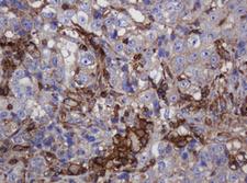 FNDC4 Antibody - IHC of paraffin-embedded Adenocarcinoma of Human colon tissue using anti-FNDC4 mouse monoclonal antibody.