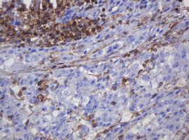 FNDC4 Antibody - IHC of paraffin-embedded Carcinoma of Human liver tissue using anti-FNDC4 mouse monoclonal antibody.
