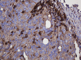 FNDC4 Antibody - IHC of paraffin-embedded Adenocarcinoma of Human ovary tissue using anti-FNDC4 mouse monoclonal antibody.