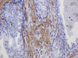 FNDC4 Antibody - IHC of paraffin-embedded Carcinoma of Human prostate tissue using anti-FNDC4 mouse monoclonal antibody.
