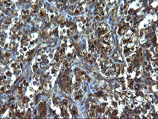 FNDC8 Antibody - IHC of paraffin-embedded Carcinoma of Human kidney tissue using anti-FNDC8 mouse monoclonal antibody. (Heat-induced epitope retrieval by 1 mM EDTA in 10mM Tris, pH8.5, 120°C for 3min).