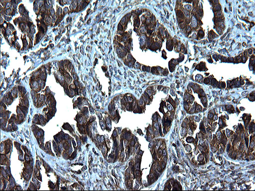 FNDC8 Antibody - IHC of paraffin-embedded Adenocarcinoma of Human ovary tissue using anti-FNDC8 mouse monoclonal antibody. (Heat-induced epitope retrieval by 1 mM EDTA in 10mM Tris, pH8.5, 120°C for 3min).