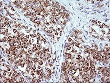 FNDC8 Antibody - IHC of paraffin-embedded Carcinoma of Human liver tissue using anti-FNDC8 mouse monoclonal antibody. (Heat-induced epitope retrieval by 1 mM EDTA in 10mM Tris, pH8.5, 120°C for 3min).