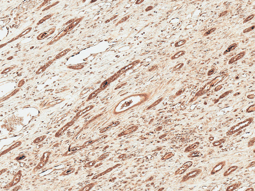 FNIP1 Antibody - Immunohistochemistry analysis using Rabbit Anti-FNP1 Polyclonal Antibody. Tissue: Renal Cell Carcinoma. Species: Human. Fixation: Formalin Fixed Paraffin-Embedded. Primary Antibody: Rabbit Anti-FNP1 Polyclonal Antibody  at 1:50 for 30 min at RT. Counterstain: Hematoxylin. Magnification: 10X. HRP-DAB Detection.
