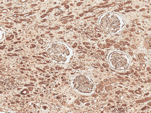 FNIP1 Antibody - Immunohistochemistry analysis using Rabbit Anti-FNP1 Polyclonal Antibody. Tissue: Renal Cell Carcinoma. Species: Human. Fixation: Formalin Fixed Paraffin-Embedded. Primary Antibody: Rabbit Anti-FNP1 Polyclonal Antibody  at 1:50 for 30 min at RT. Counterstain: Hematoxylin. Magnification: 10X. HRP-DAB Detection.