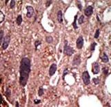 FNTB Antibody - Formalin-fixed and paraffin-embedded human cancer tissue reacted with the primary antibody, which was peroxidase-conjugated to the secondary antibody, followed by DAB staining. This data demonstrates the use of this antibody for immunohistochemistry; clinical relevance has not been evaluated. BC = breast carcinoma; HC = hepatocarcinoma.