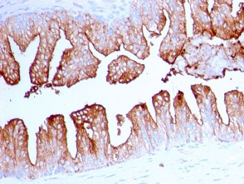 FOLH1 / PSMA Antibody - IHC testing of FFPE human prostate cancer with FOLH1 antibody. Required HIER: boil tissue sections in 10mM citrate buffer, pH 6, for 10-20 min and allow to cool before testing.