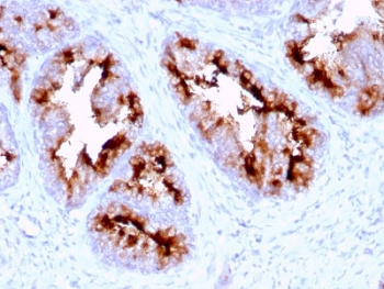 FOLH1 / PSMA Antibody - IHC testing of FFPE human prostate carcinoma with FOLH1 antibody. Required HIER: boil tissue sections in 10mM citrate buffer, pH 6, for 10-20 min and allow to cool before testing.