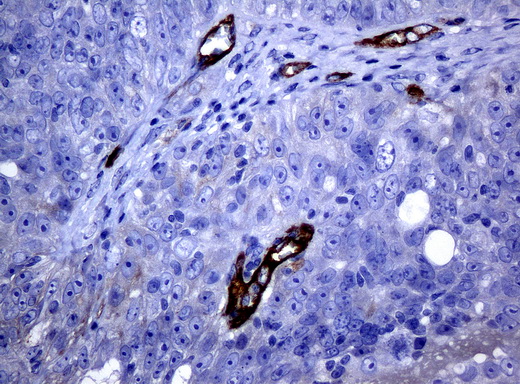 FOLH1 / PSMA Antibody - Immunohistochemical staining of paraffin-embedded Adenocarcinoma of ovary tissue using anti-FOLH1mouse monoclonal antibody. (Clone UMAB25, dilution 1:100; heat-induced epitope retrieval by 10mM citric buffer, pH6.0, 120C for 3min)