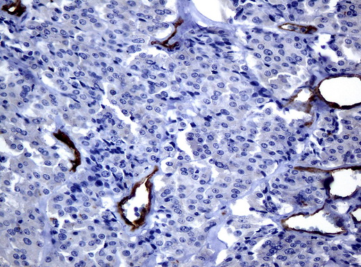 FOLH1 / PSMA Antibody - Immunohistochemical staining of paraffin-embedded Carcinoma of thyroid tissue using anti-FOLH1mouse monoclonal antibody. (Clone UMAB25, dilution 1:100; heat-induced epitope retrieval by 10mM citric buffer, pH6.0, 120C for 3min)
