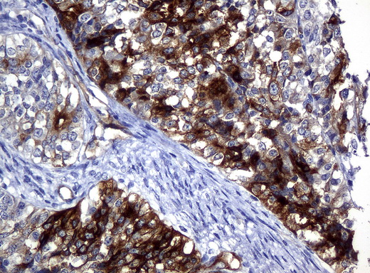FOLH1 / PSMA Antibody - Immunohistochemical staining of paraffin-embedded Adenocarcinoma of endometrium tissue using anti-FOLH1mouse monoclonal antibody. (Clone UMAB25, dilution 1:100; heat-induced epitope retrieval by 10mM citric buffer, pH6.0, 120C for 3min)