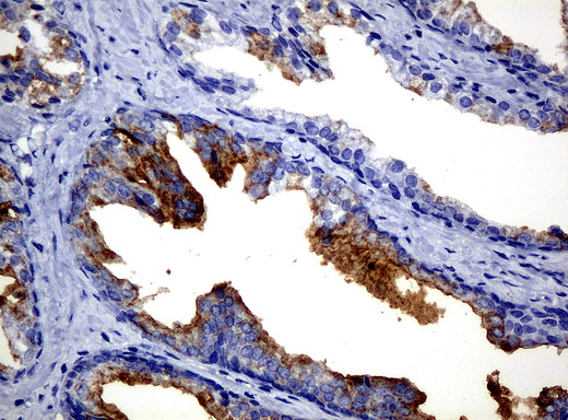 FOLH1 / PSMA Antibody - Immunohistochemical staining of paraffin-embedded Carcinoma of prostate tissue using anti-FOLH1mouse monoclonal antibody. (Clone UMAB25, dilution 1:100; heat-induced epitope retrieval by 10mM citric buffer, pH6.0, 120C for 3min)
