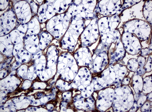 FOLH1 / PSMA Antibody - Immunohistochemical staining of paraffin-embedded Carcinoma of kidney tissue using anti-FOLH1mouse monoclonal antibody. (Clone UMAB25, dilution 1:100; heat-induced epitope retrieval by 10mM citric buffer, pH6.0, 120C for 3min)