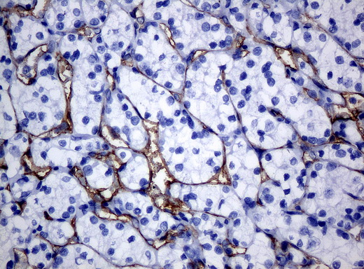 FOLH1 / PSMA Antibody - Immunohistochemical staining of paraffin-embedded Carcinoma of kidney tissue using anti-FOLH1mouse monoclonal antibody. (Clone UMAB26, dilution 1:100; heat-induced epitope retrieval by 10mM citric buffer, pH6.0, 120C for 3min)