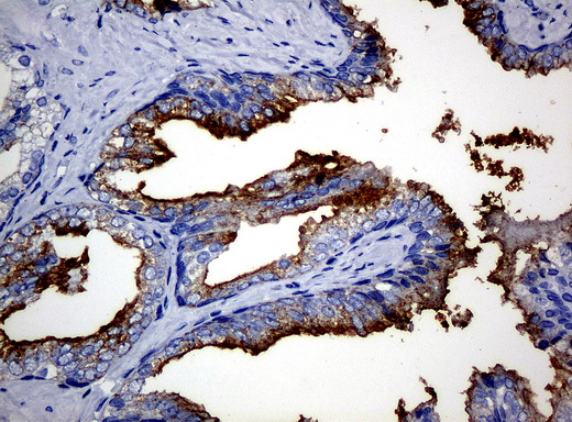 FOLH1 / PSMA Antibody - Immunohistochemical staining of paraffin-embedded Carcinoma of prostate tissue using anti-FOLH1mouse monoclonal antibody. (Clone UMAB26, dilution 1:100; heat-induced epitope retrieval by 10mM citric buffer, pH6.0, 120C for 3min)