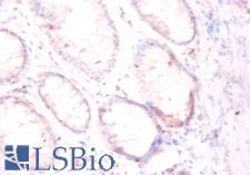 FOLH1 / PSMA Antibody - Immunohistochemistry of paraffin-embedded human colorectal carcinoma using FOLH1 / PSMA antibody at dilution of 1:50.  This image was taken for the unconjugated form of this product. Other forms have not been tested.